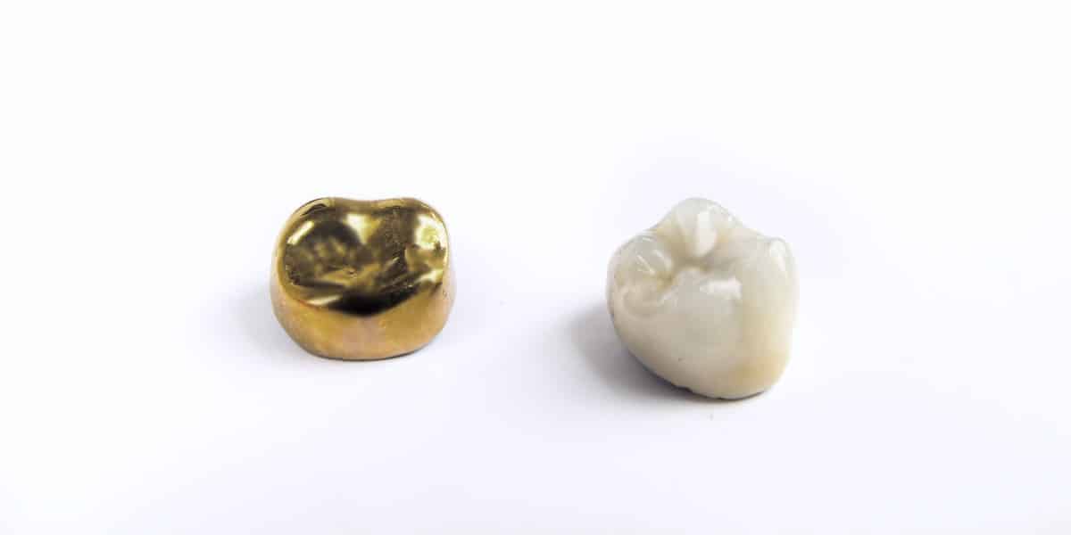 dental crowns - Wortley Road Dental