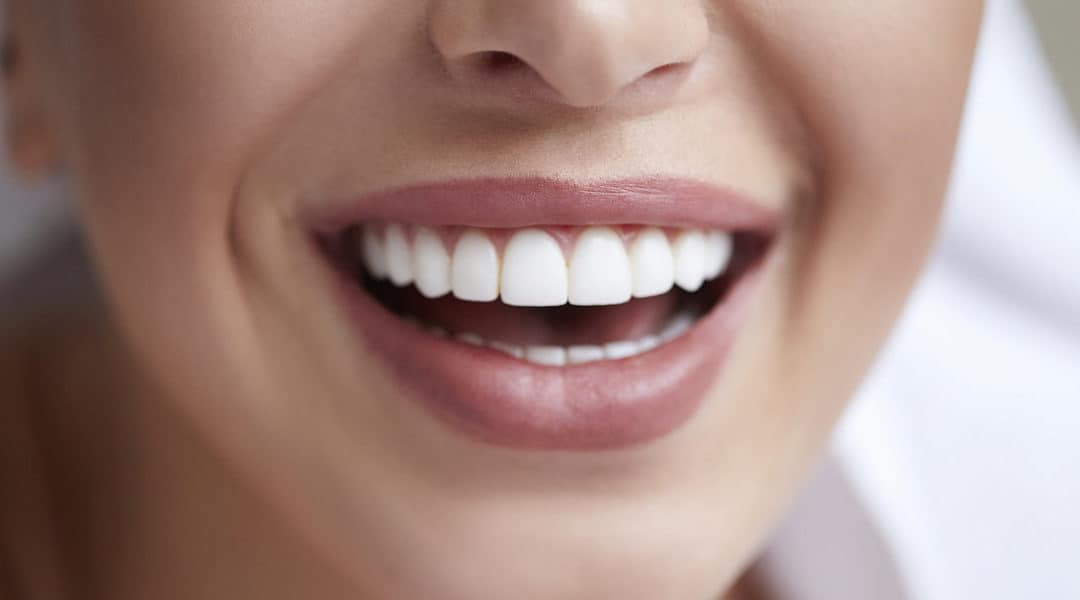 How Much Do Veneers Cost?