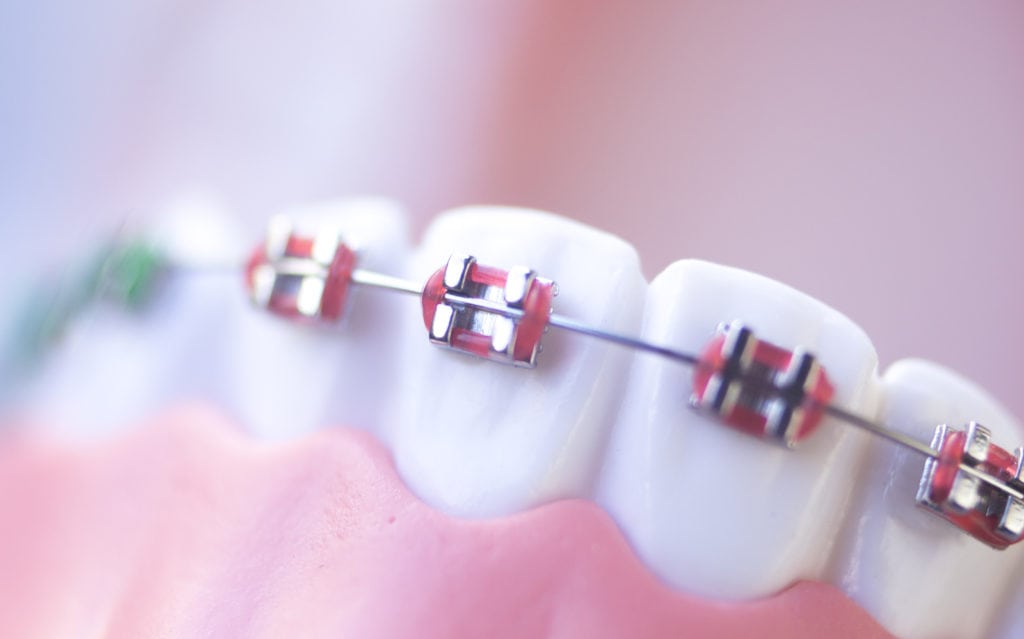 orthodontics London, ON - Wortley Road Dental