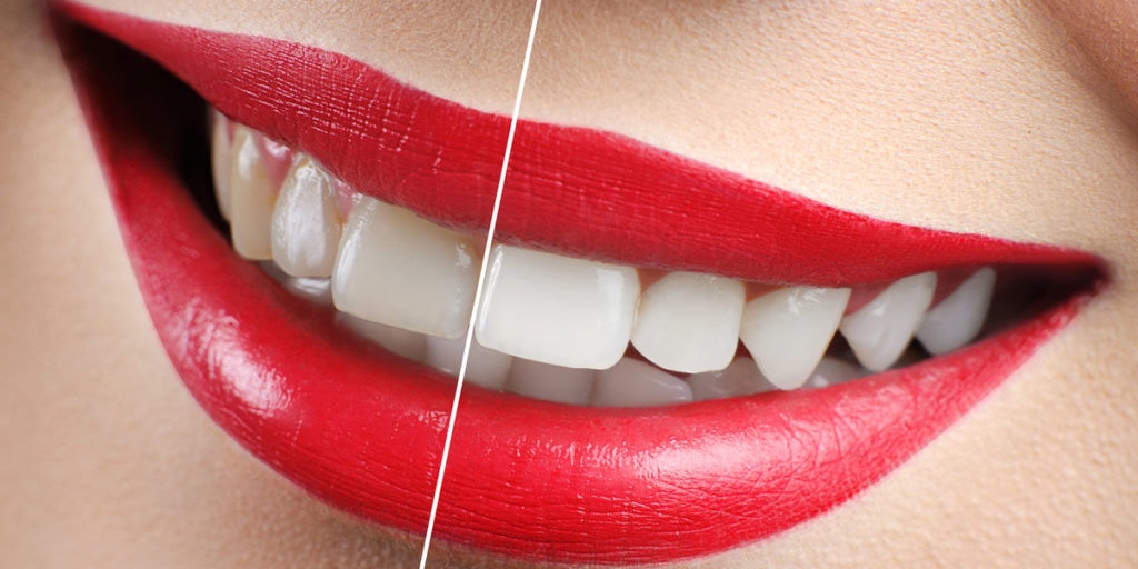 teeth whitening by Wortley Road Dental