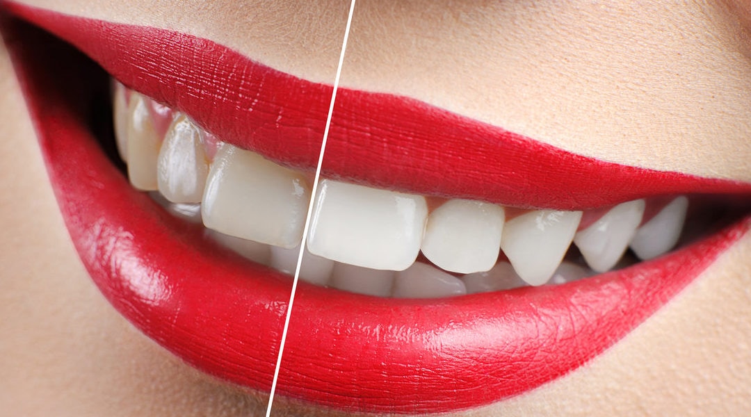 Proceed with Caution: Teeth-whitening Truths
