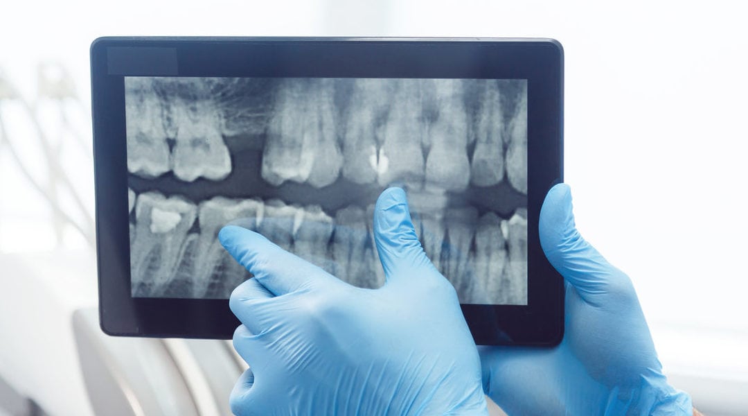 Potential Root Canal Problems You Need To Be Aware