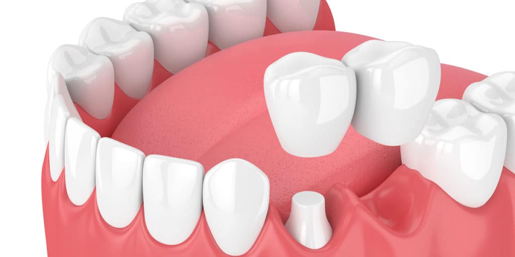 You Can Improve Your Overall Health With Dental Bridges