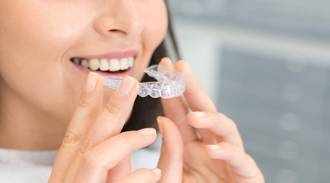 Considering Clear Braces? Then You’ll Love These Tips