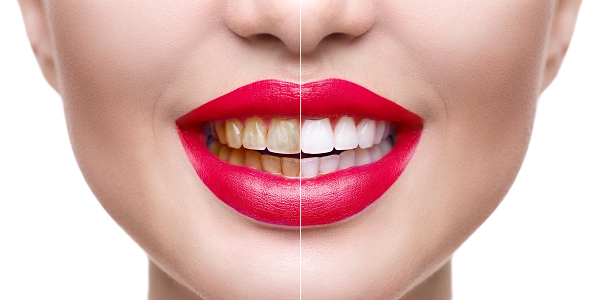 Woman Teeth Before and After White