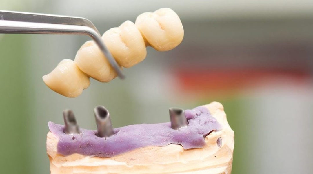 Want To Restore Your Smile? Check Out Dental Bridges