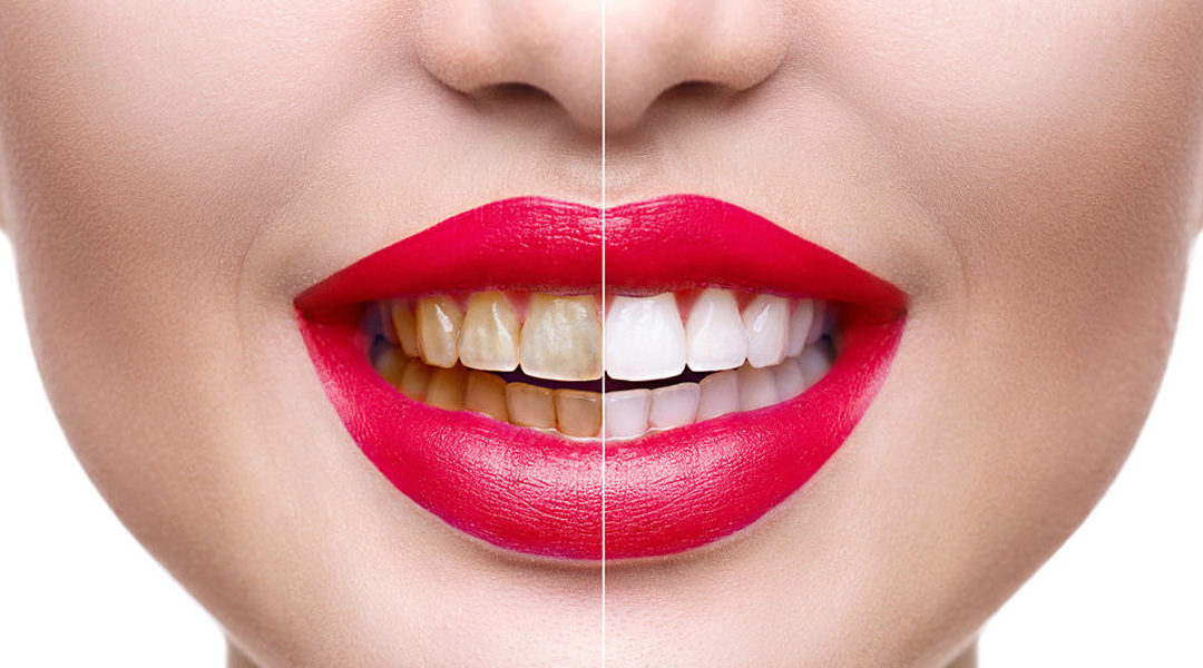 Three Ways Cosmetic Dentistry Can Make Your Life Better