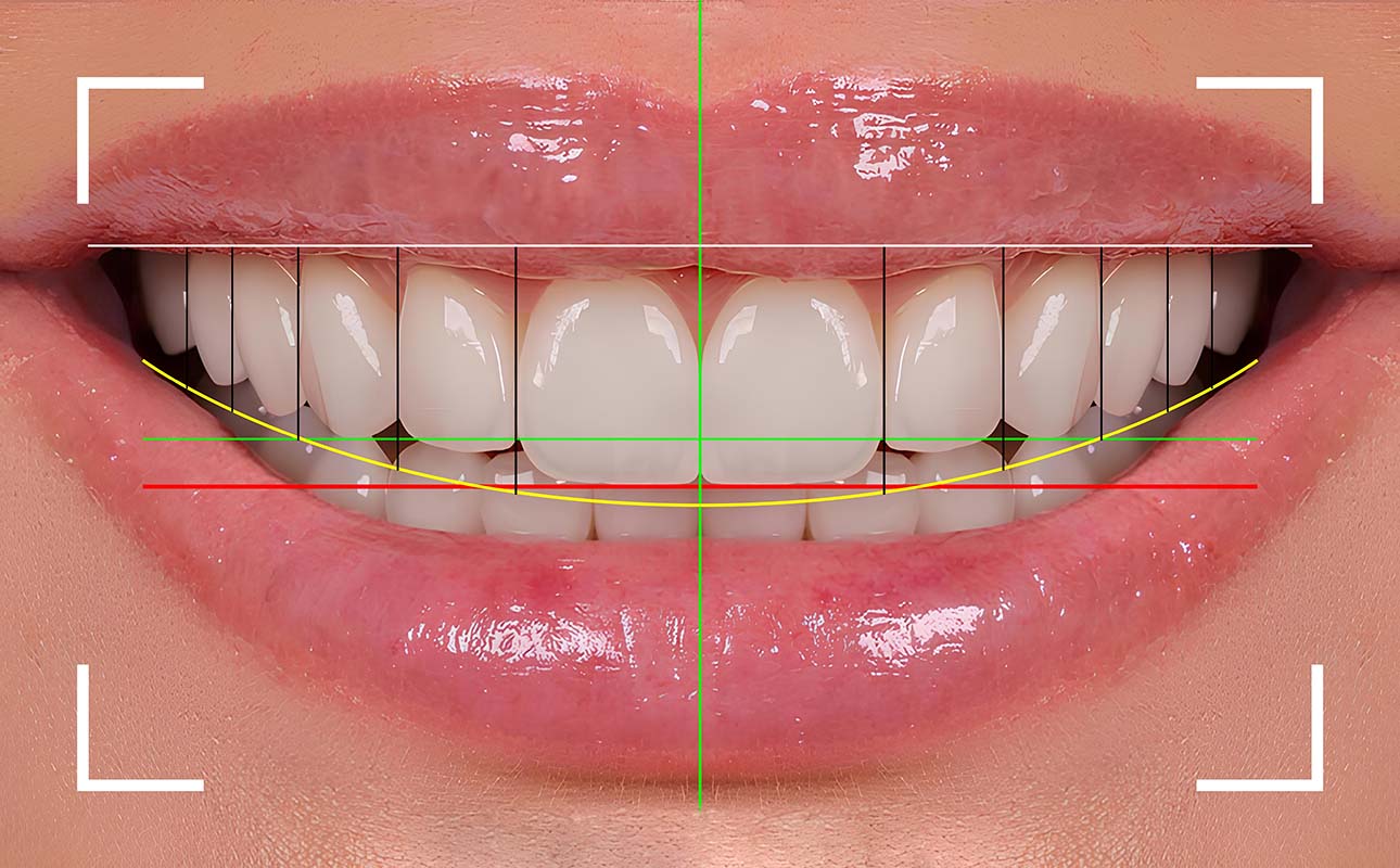 Digital Smile Design